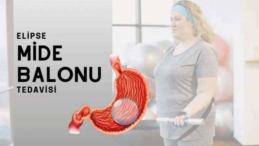 Mide Balonu Fiyatları